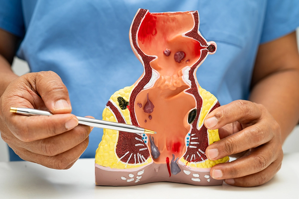 Four-grade haemorrhoid classification diagram showing prolapse severity from Grade I to Grade IV