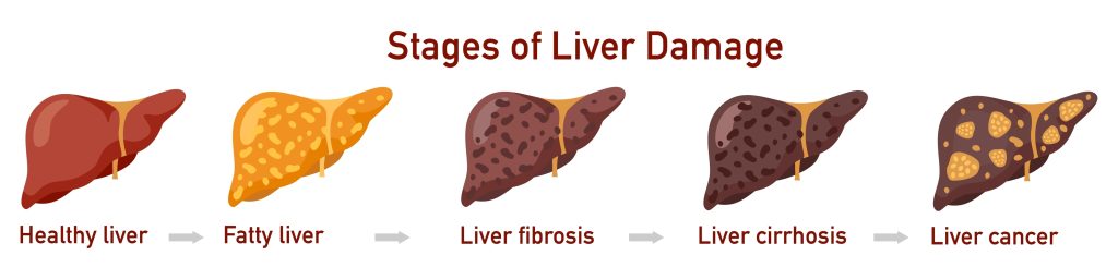 Liver surgery cost spectrum Singapore from biopsy to transplant with TOSP codes and MediSave status