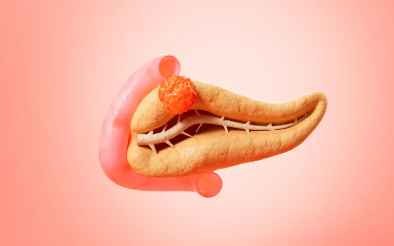 Illustration of the pancreas highlighting neuroendocrine tumour location
