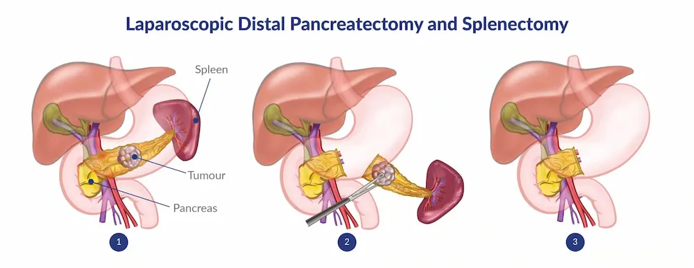 Three-step illustration of laparoscopic distal pancreatectomy and splenectomy, showing the pancreas, tumour and spleen before, during and after removal