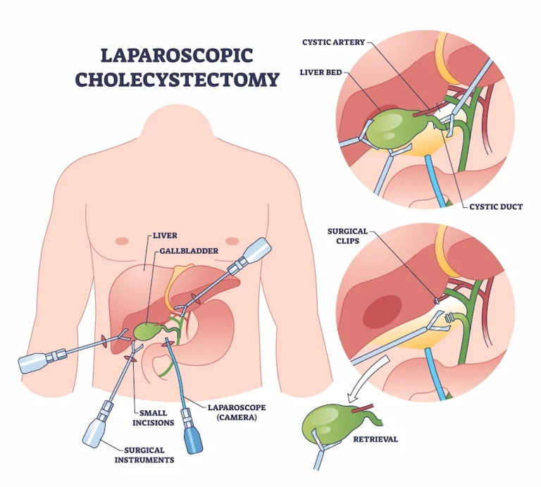 Diagram of laparoscopic cholecystectomy showing gallbladder removal