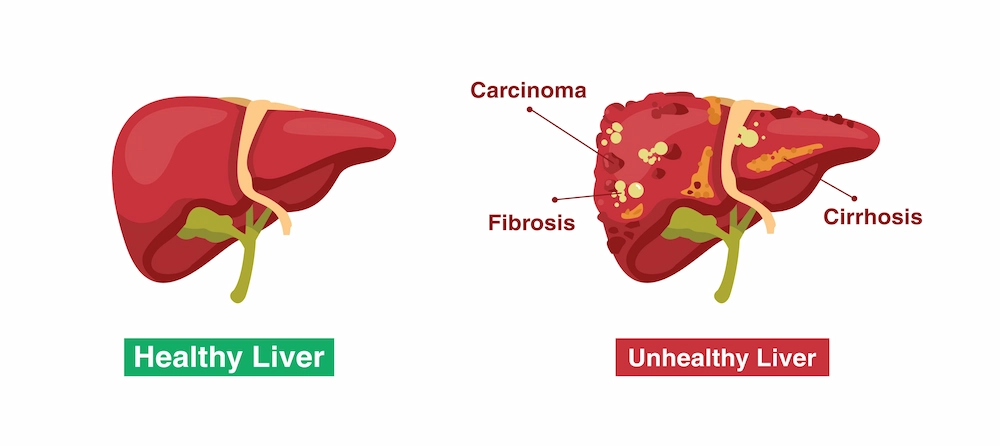 Illustration comparing a healthy liver with an unhealthy liver showing fibrosis, cirrhosis and carcinoma
